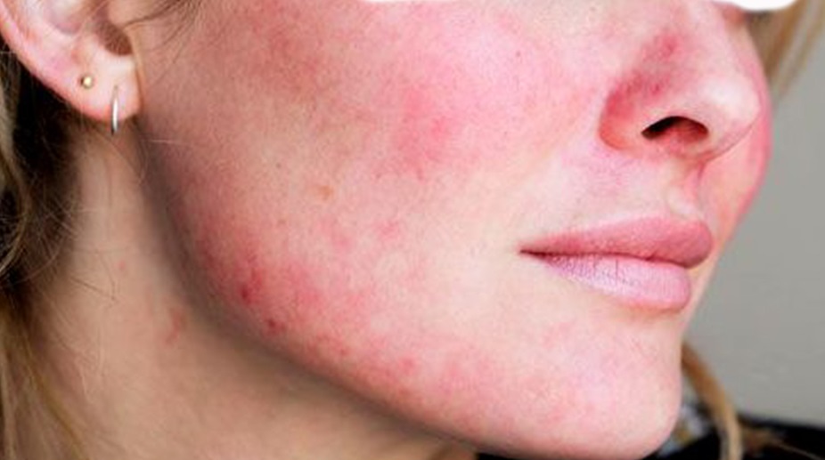 rosacea.jpg rosacea.jpg